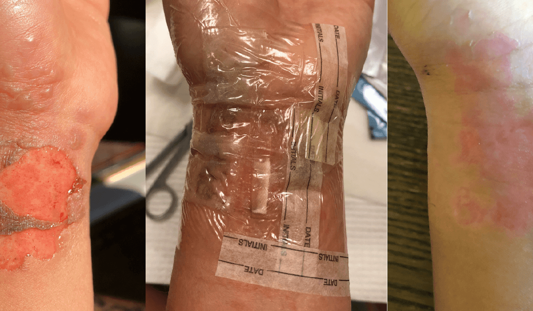 Burn Injury on Wrist, Treated with BloodSTOP iX