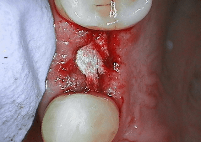 Case Study: BloodSTOP® iX Used on Conservative Implant Surgery Site