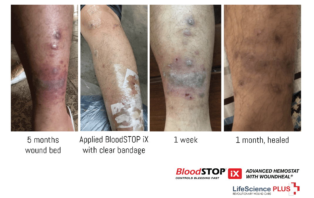 Case Study: BloodSTOP® iX Heals 5-month-old Chronic Ulcer Wound