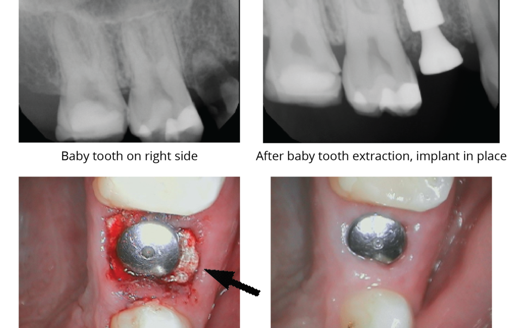 Case Study: BloodSTOP® iX Used in Baby Tooth Extraction and Successfully Achieved Hemostasis in Soft Tissue Wounds in the Gums