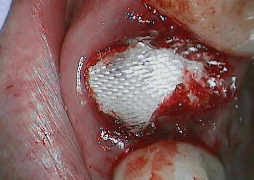 BloodSTOP®️ iX Used on Dental Implant Site