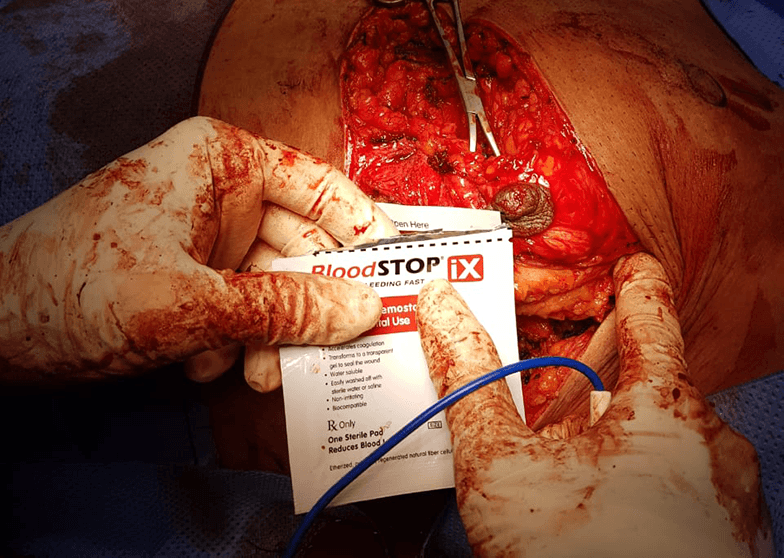 Case Study: BloodSTOP® iX Used in Gynecomastia Surgery