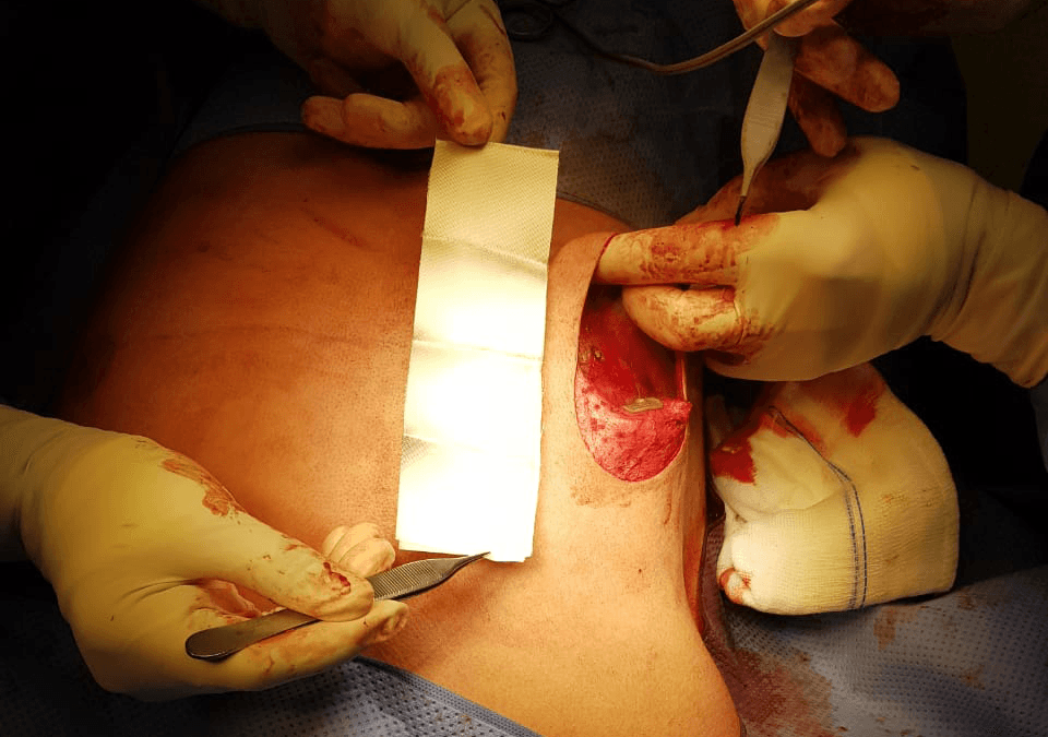 BloodSTOP iX Used in Gynecomastia Surgery