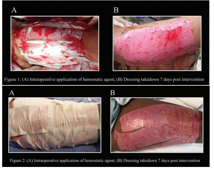 Decreased Healing Time in Split-Thickness Skin Grafts