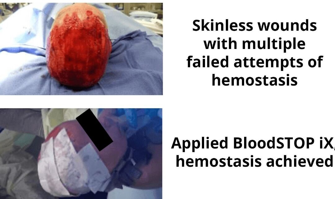 Open Wounds Healed with BloodSTOP iX When No Products Succeeded