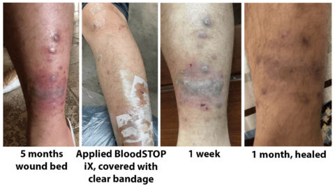 Chronic Wound Care - LifeScience Plus | BloodSTOP