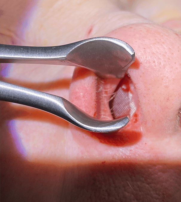 Management of Acute and Recurrent Epistaxis in an Office Setting